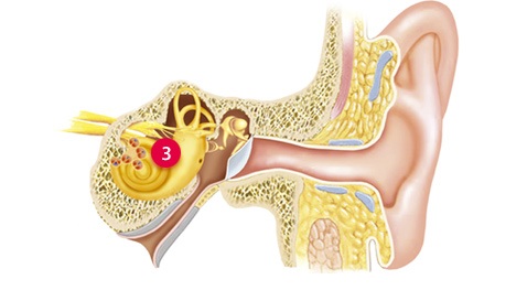 Conductive hearing loss diagram